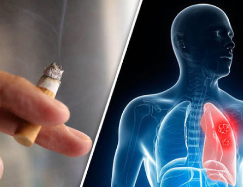 The link between smoking and lung cancer